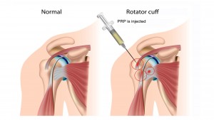 PRP-Rotator-Cuff-Injuries-Graphic